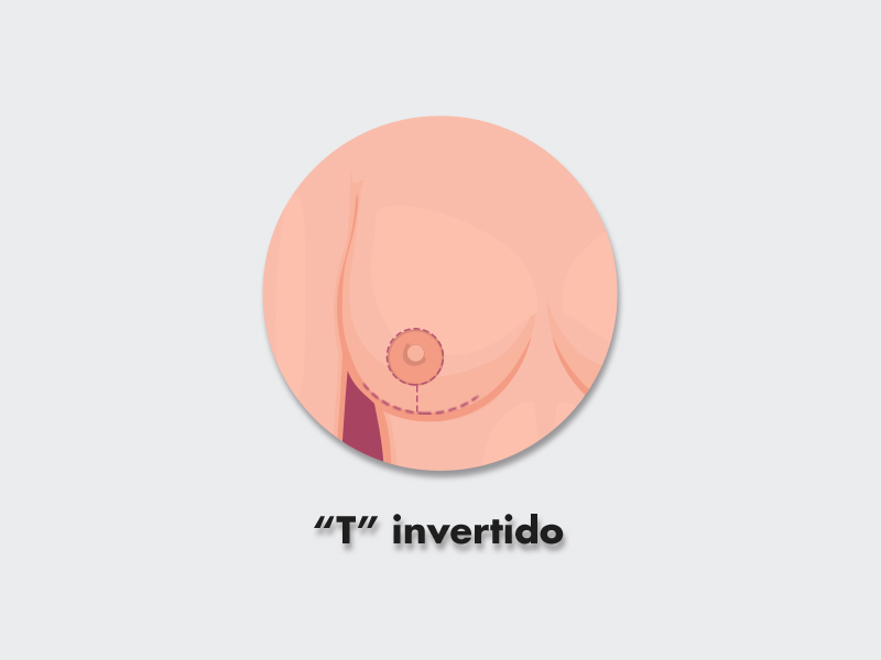 Ilustração de T invertido na mamoplastia