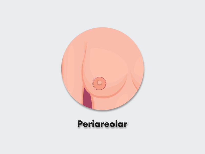 Ilustração de cicatriz periareolar na cirurgia de mama
