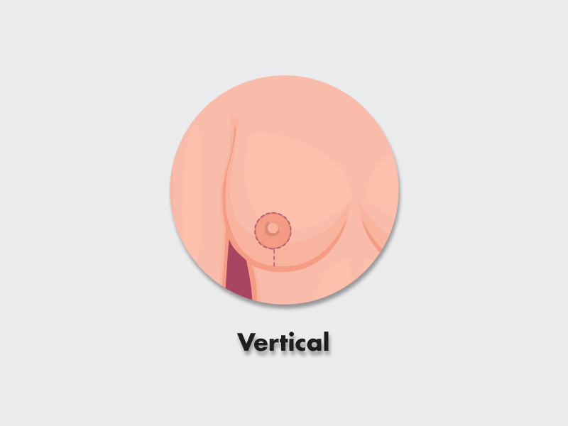 Ilustração da cicatriz da mamoplastia redutora com prótese vertical