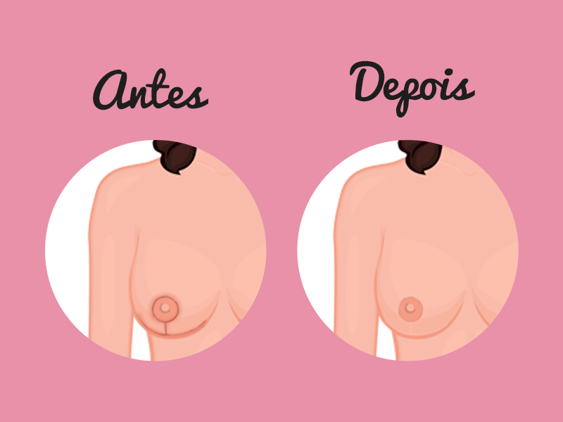 Ilustração de antes e depois da cicatriz de mamoplastia 