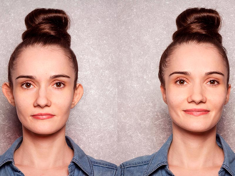 Antes e depois da cirurgia de orelha de mulher