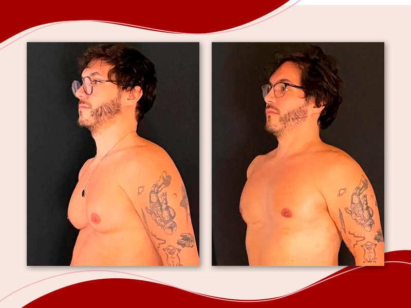 Antes e depois da cirurgia de ginecomastia de Elizer