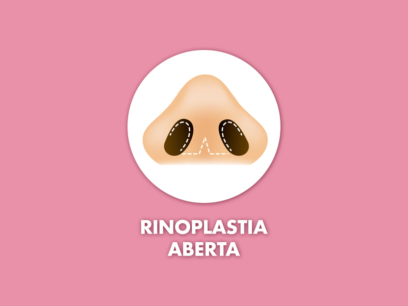 rinoplastia aberta