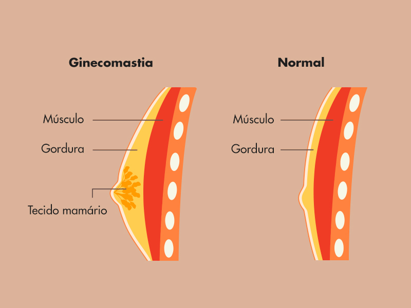 O que é Ginecomastia? ginecomastia masculina