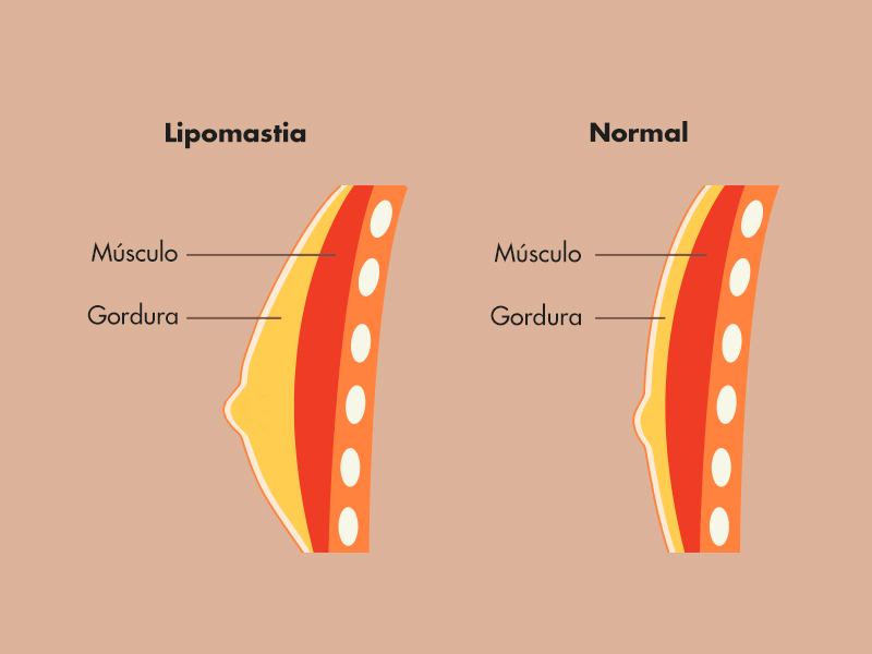 cirurgia gordura peitoral