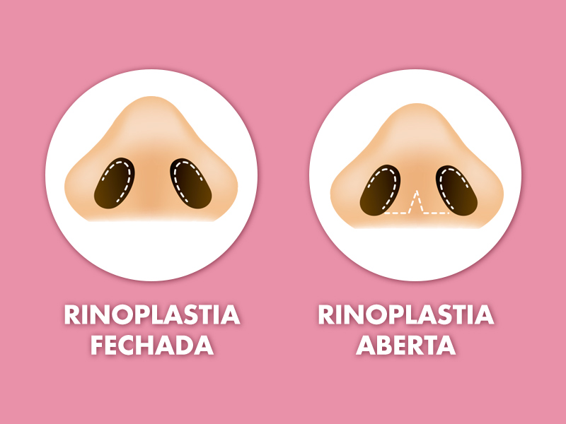 rinoplastia aberta estruturada