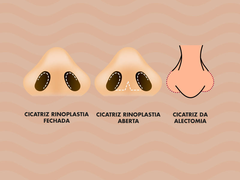 Ilustração com os três tipos de cicatriz da rinoplastia