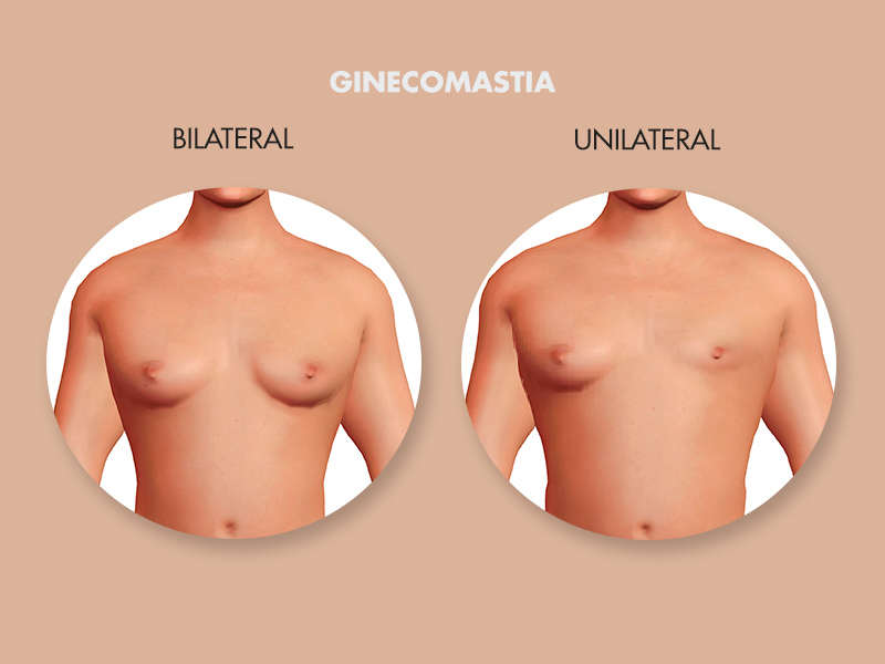 ginecomastia bilateral unilateral