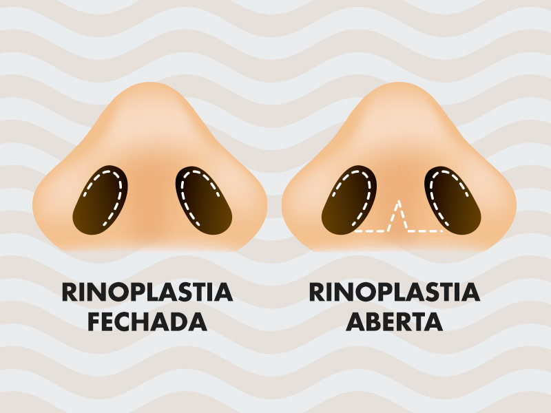 comparativo rinoplastia aberta fechada