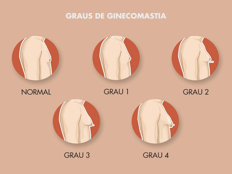 ginecomastia grau 1 2 3 