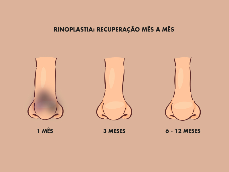 Ilustração para mostrar a evolução da rinoplastia 3 meses depois