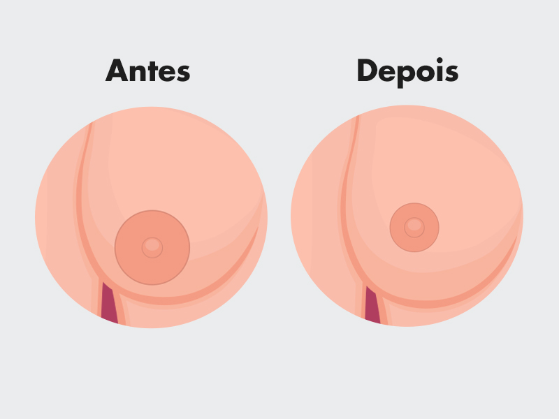 Ilustração que mostra o resultado da cirurgia de mamilo 