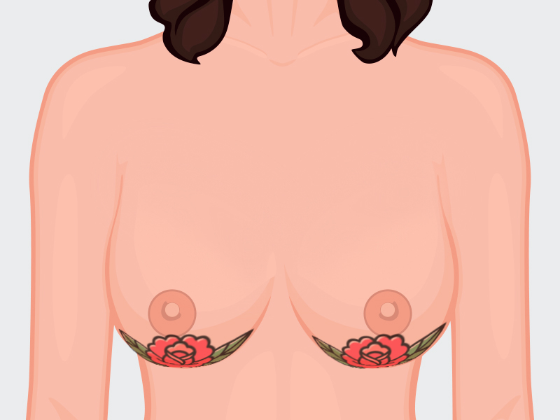 Ilustração de tatuagem na cicatriz da mamoplastia com flores