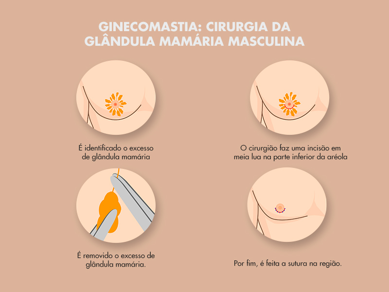 ginecomastia procedimento