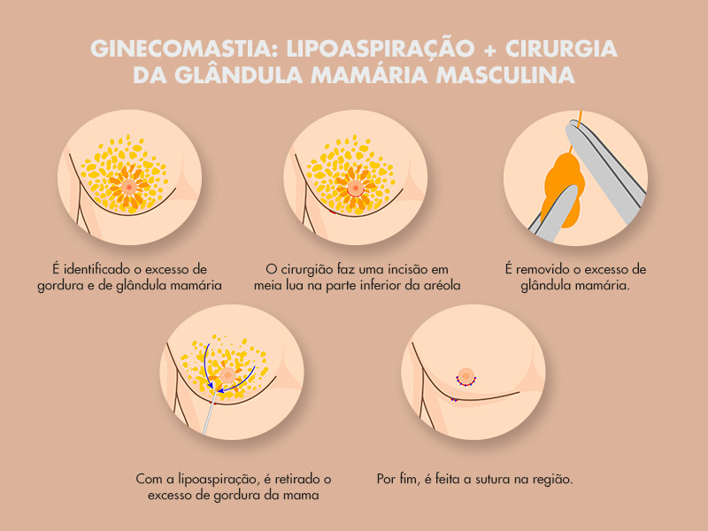 ginecomastia lipoaspiracao 