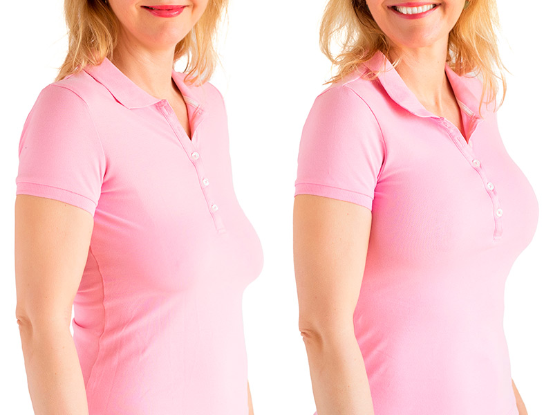 Antes e depois da cirurgia de lifting mamário de mulher de camiseta polo rosa