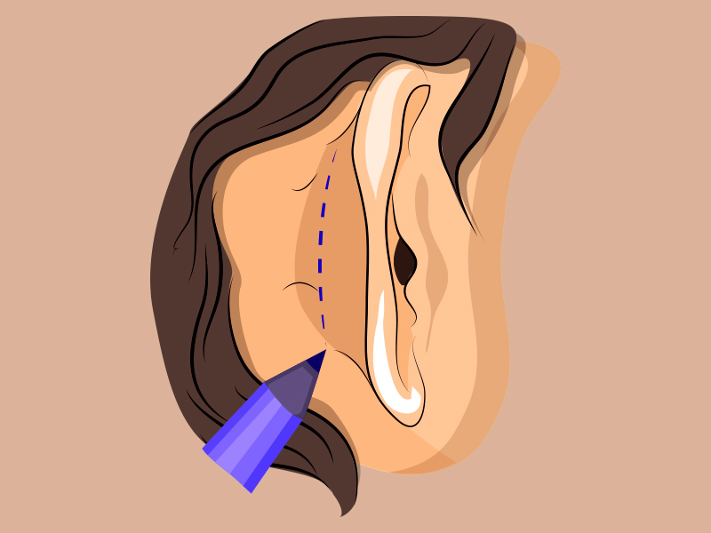Ilustração de como fica a cicatriz da otoplastia atrás da orelha