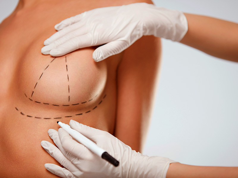 Conheça a cirurgia de lifting de mama Mãos com luvas brancas fazendo as marcas na mama para a cirurgia lifting de mama