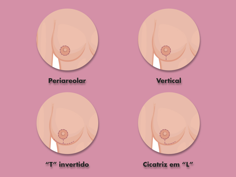 4 tipos de cicatriz do lifting de mama, t invertido, periareolar, vertical e em L