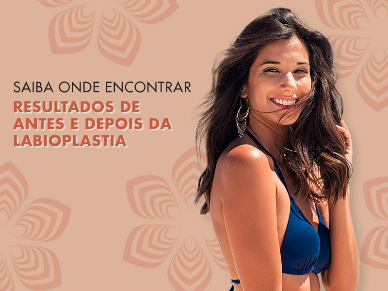Labioplastia antes e depois: saiba como conquistar um ótimo resultado na cirurgia de hipertrofia dos pequenos lábios! labioplastia antes depois