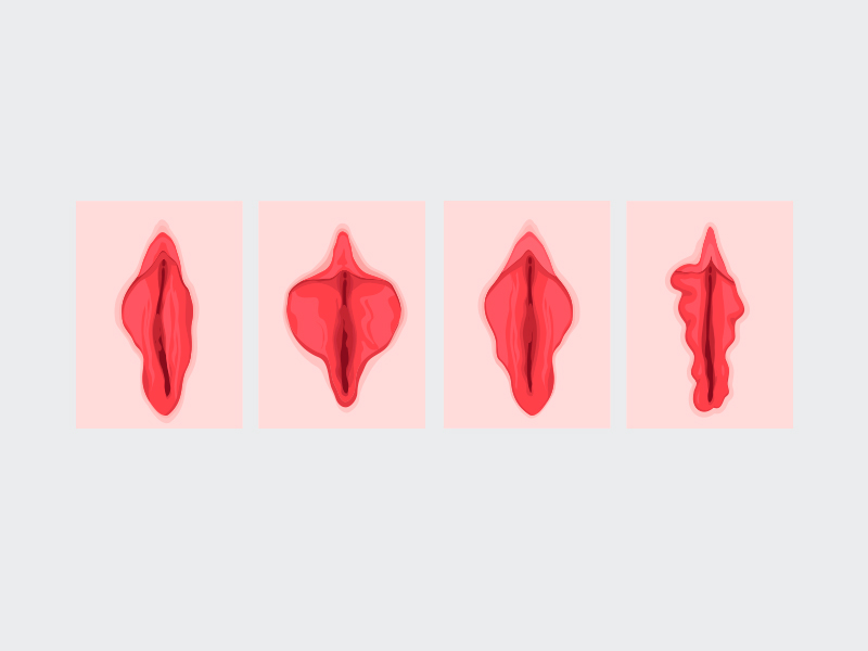 O que é ninfoplastia? nifoplastia