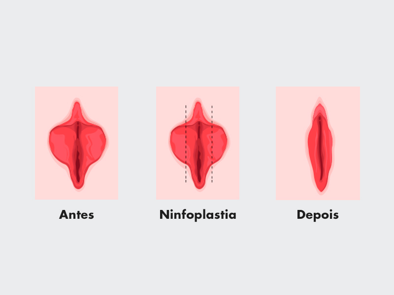 Passo a passo da Ninfoplastia feita ninfoplastia