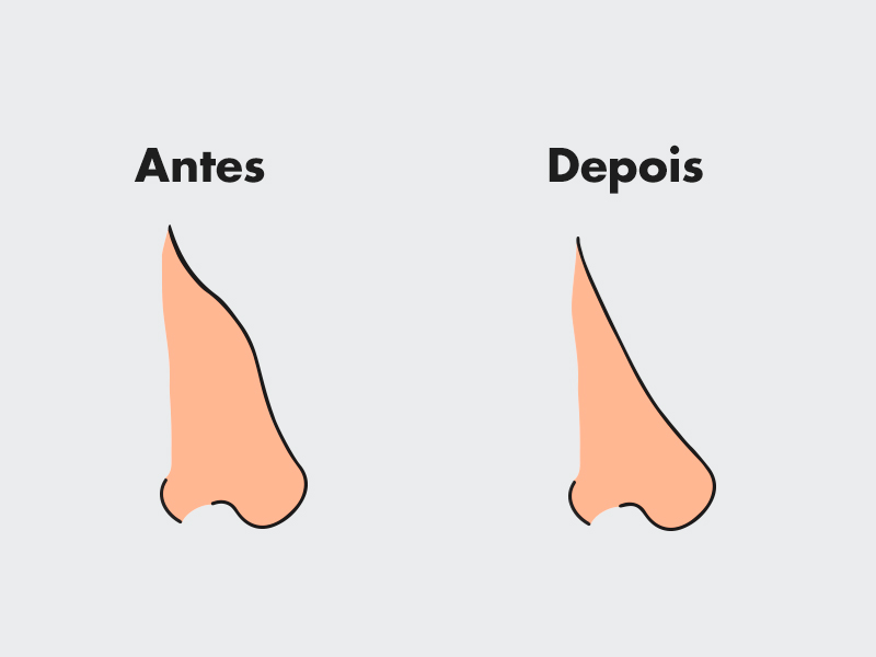 Ilustração exemplificando como é o antes e depois da rinoplastia reparadora