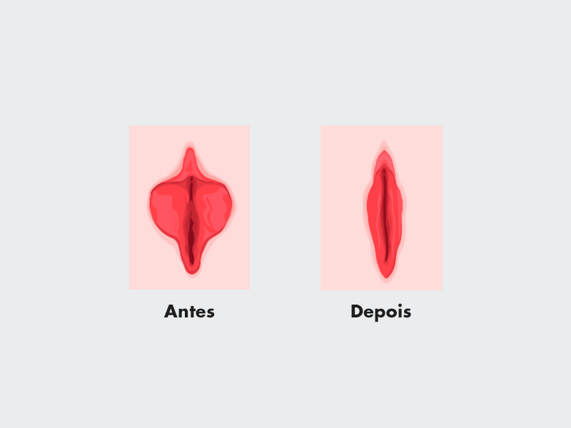 Antes e depois da cirurgia de Ninfo cicatriz ninfoplastia