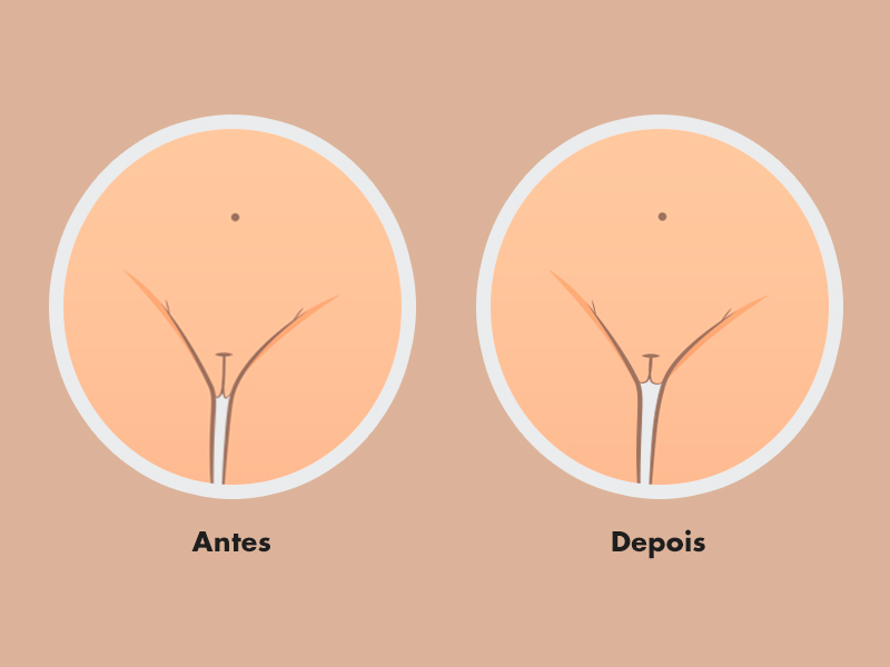 labioplastia grandes lábios antes depois