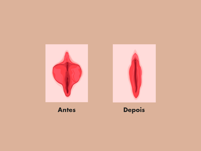 Como é o antes e depois da labioplastia nos grandes lábios? exercicios diminuir grandes labios