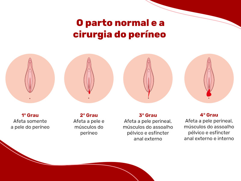  Imagem mostra os 4 graus de laceração após o parto normal.