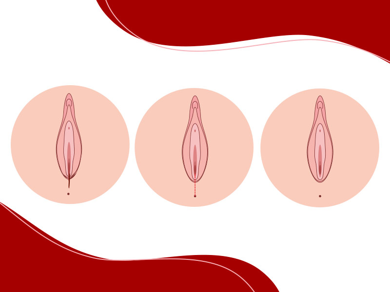 Imagem mostrando o resultado da cirurgia de períneo, o antes, durante e depois.