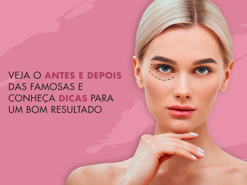 Blefaroplastia Antes e Depois: Saiba como ter um resultado excelente na cirurgia de pálpebras blefaroplastia antes depois