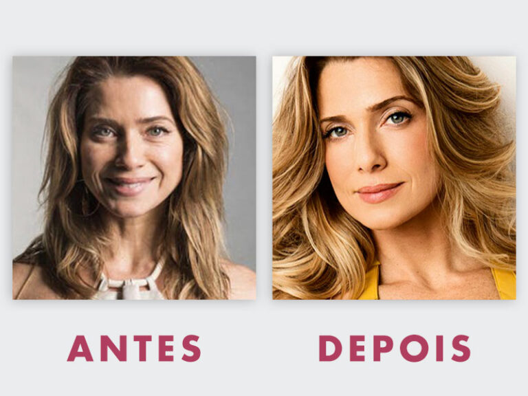 Blefaroplastia Antes e Depois - Fotos e Resultados | Dream Plastic