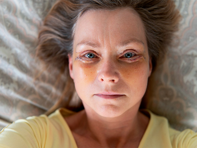 Imagem do rosto de uma mulher com equimose após blefaroplastia