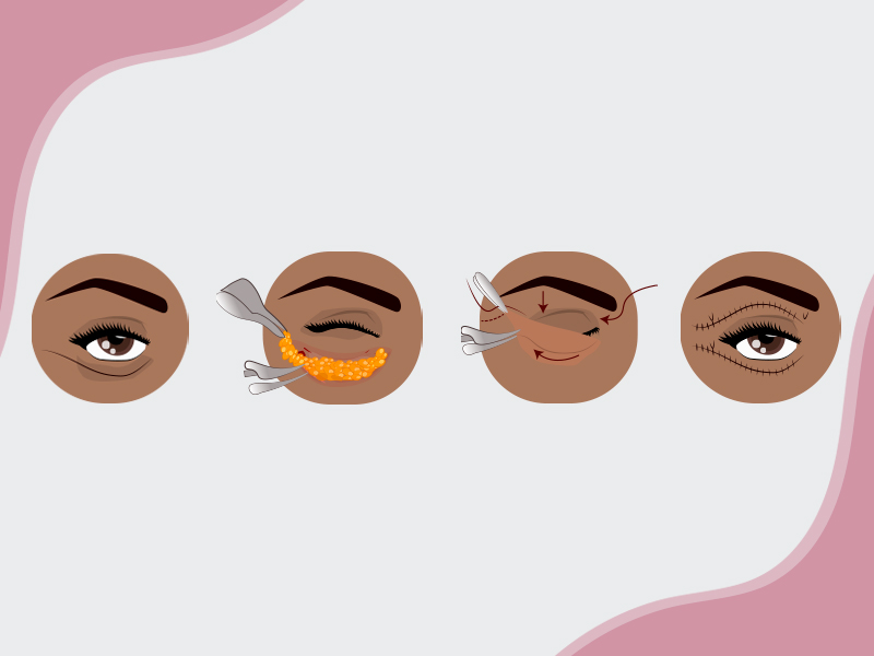Como é feita a cirurgia abaixo dos olhos? blefaroplastia inferior