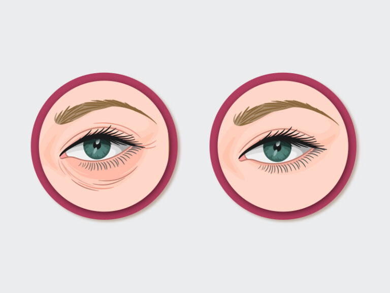 Blefaroplastia Antes e Depois - Fotos e Resultados | Dream Plastic