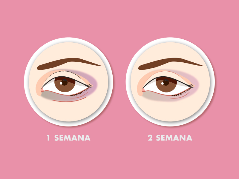 Imagem com fundo rosa e duas ilustrações representando a evolução da recuperação da blefaroplastia em duas semanas