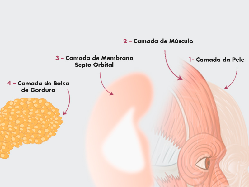 bolsa de gordura abaixo dos olhos
