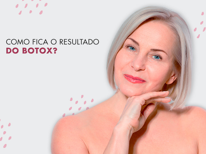 Botox antes e depois: Saiba como ter um resultado incrível igual ao das famosas botox antes depois