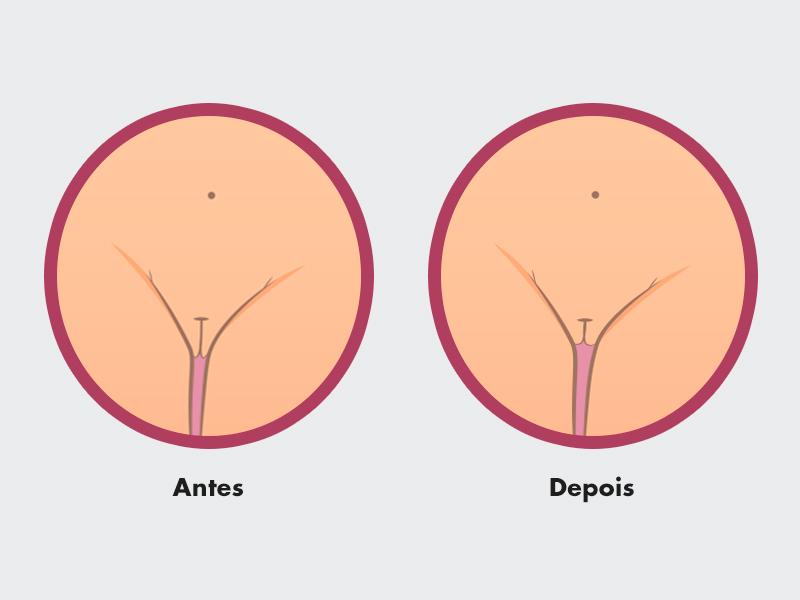 Como é o resultado da Ninfoplastia nos grandes lábios? ninfoplastia resultado