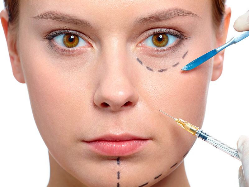 Imagem com o rosto de uma mulher em primeiro plano e marcações pontilhadas em alguns pontos de aplicação da toxina botulínica