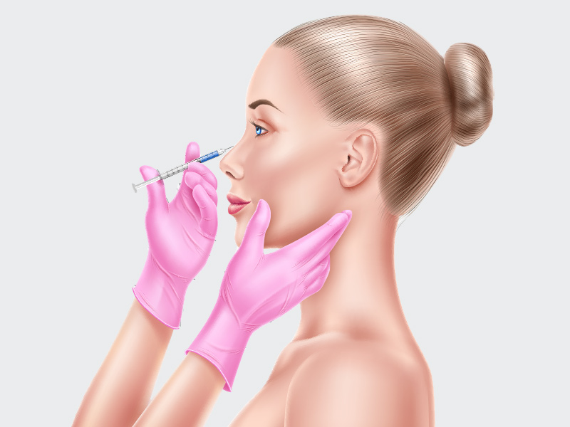 Ilustração de uma mulher realizando a aplicação da toxina botulínica no nariz.