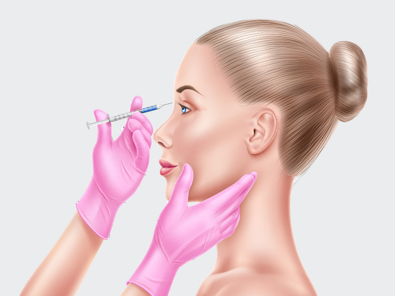 Ilustração de uma mulher realizando a aplicação de botox na glabela, região entre as sobrancelhas.