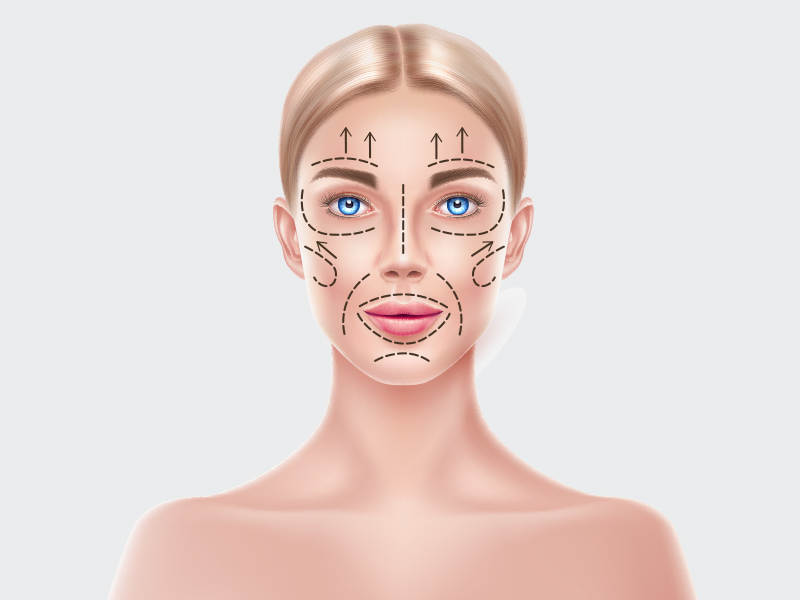 Ilustração de uma mulher com marcações no rosto, nas áreas de aplicação da toxina botulínica