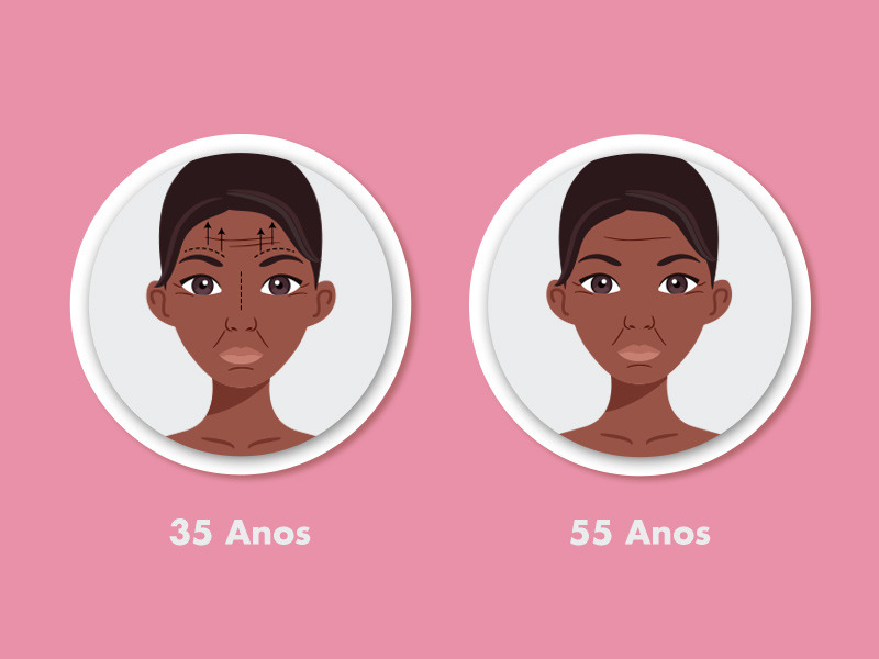 Ilustração de mulher com 35 e 55 anos com o antes e depois do botox na testa