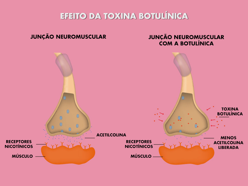 Ilustração explicando o mecanismo de ação da toxina botulínica no organismo