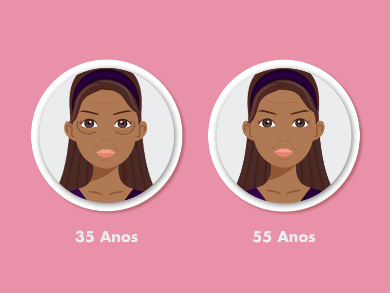 Ilustração do antes e depois do botox na testa em uma mulher com 35 e 55 anos