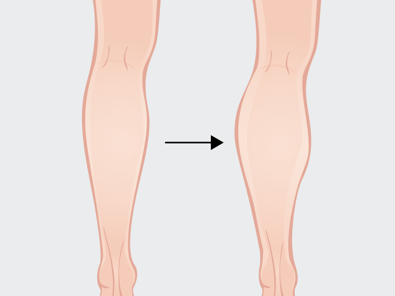 ilustração com o antes e depois do silicone na panturrilha