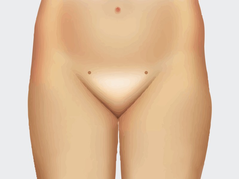 ilustração de onde fica a cicatriz da lipo de pubis